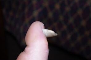 Sēnītes simptomi uz nagiem